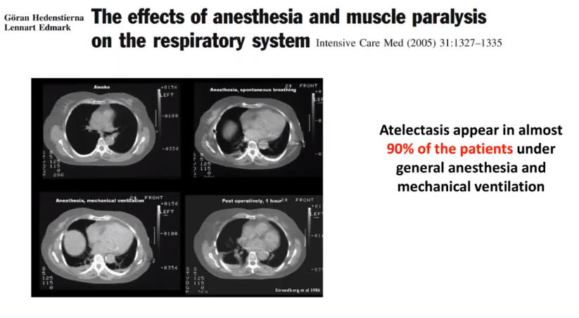 CT scans showing lung effects under anesthesia; text indicates 90% of patients face atelectasis with anesthesia.