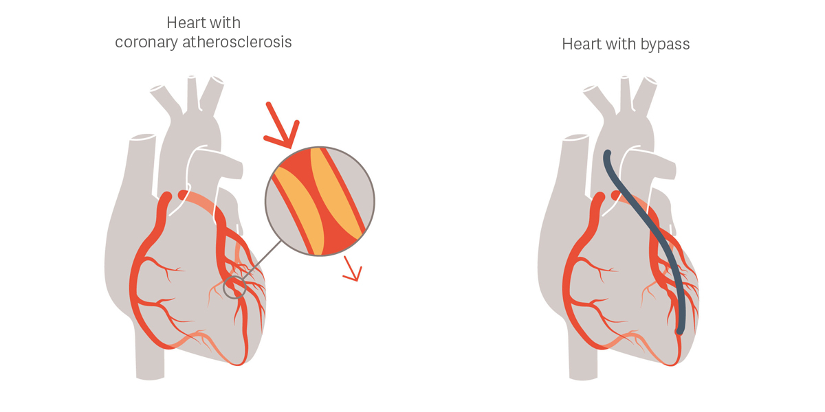 Getinge CABG illustration Getinge CABG illustration