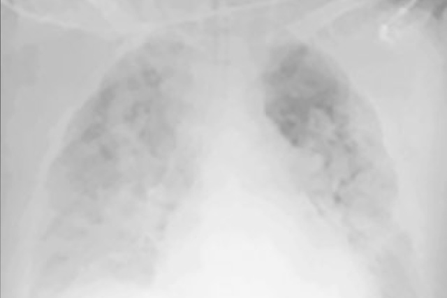 Moderate pulmonary edema
