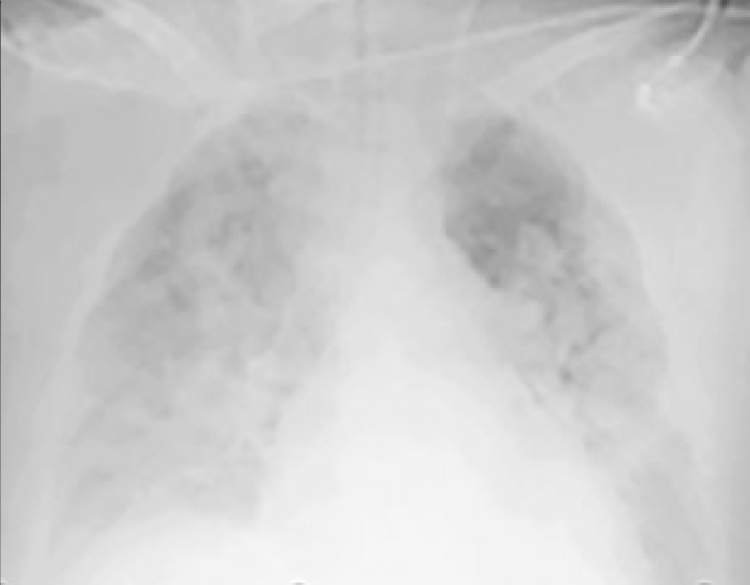 Moderate pulmonary edema