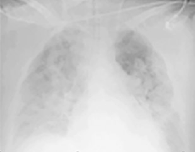 Moderate pulmonary edema Moderate pulmonary edema