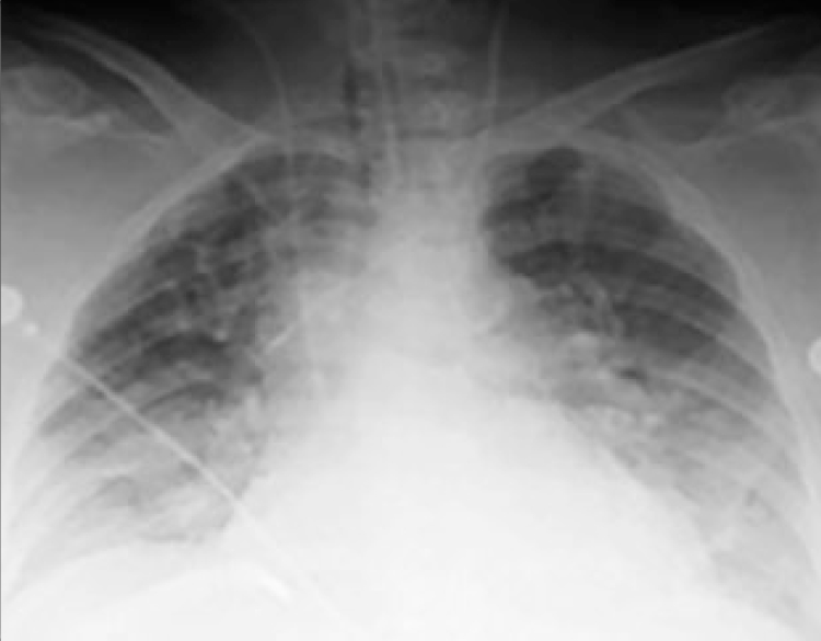 No pulmonary edema No pulmonary edema