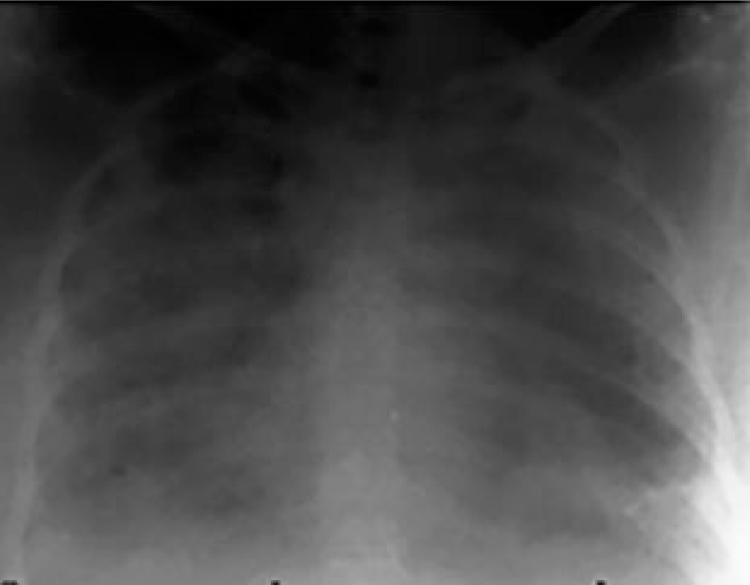 Severe pulmonary edema Severe pulmonary edema
