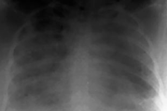 Severe pulmonary edema