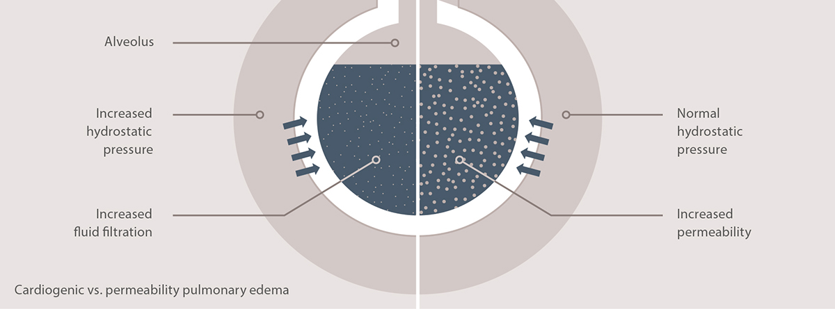 Cardiogenic vs. permeability pulmonary edema Cardiogenic vs. permeability pulmonary edema