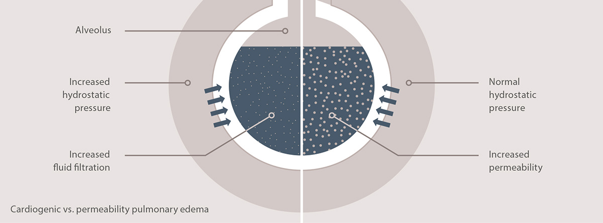 Cardiogenic vs. permeability pulmonary edema