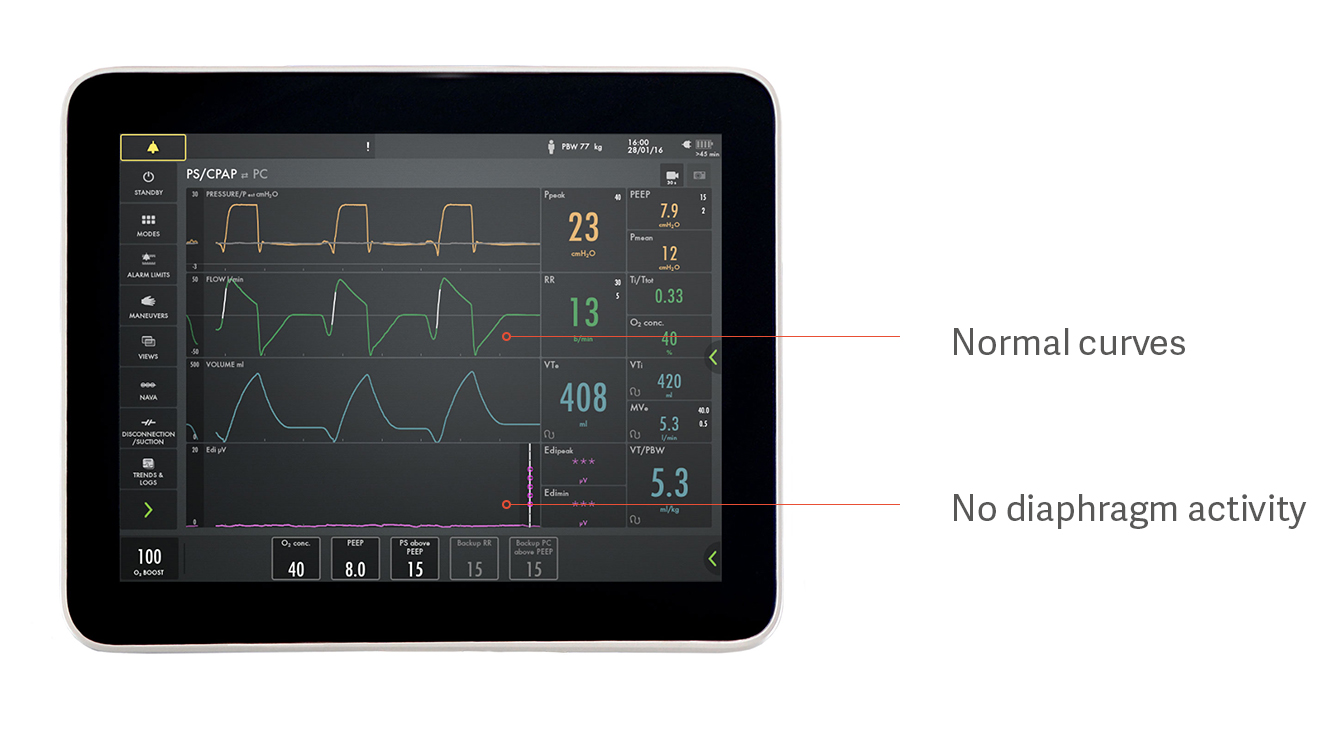 Triggering ventilator with no diaphragm activity Triggering ventilator with no diaphragm activity