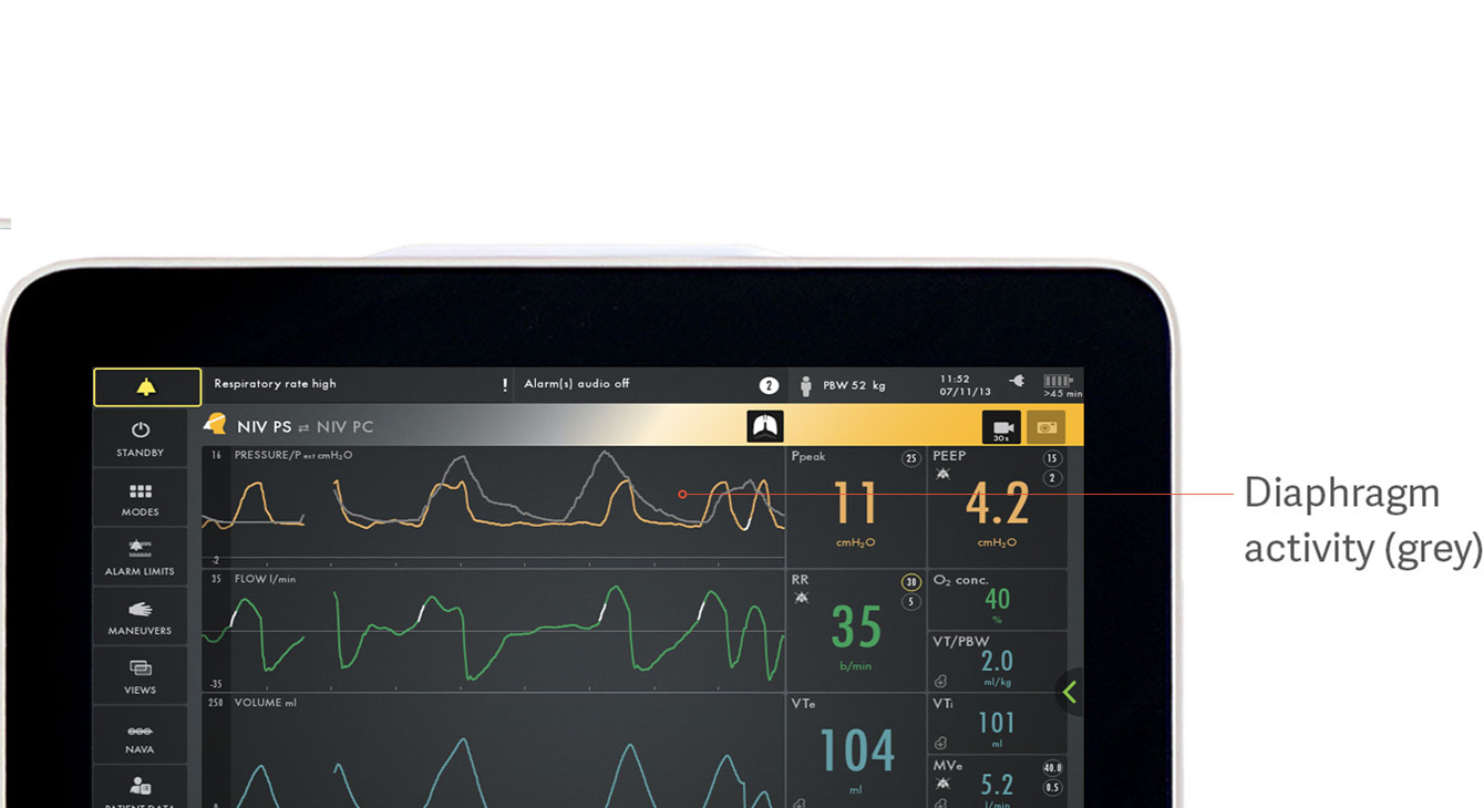 Identifying patient-ventilator asynchrony with the help of diaphragm monitoring