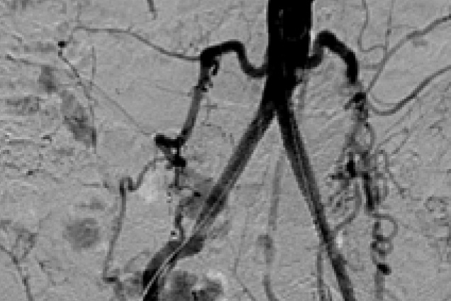 Bilateral Common Iliac artery occlusion - post restoration