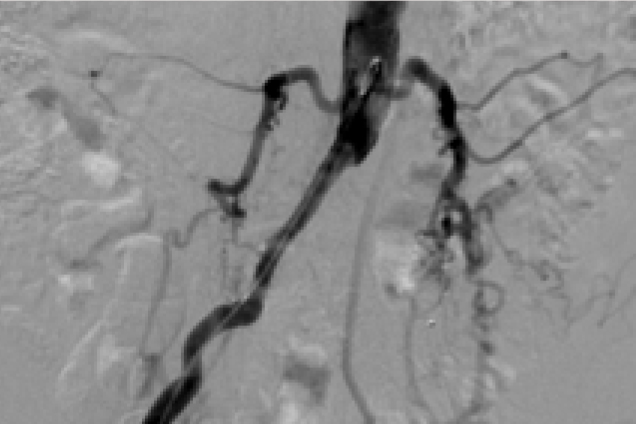Bilateral Common Iliac artery occlusion - pre restoration Bilateral Common Iliac artery occlusion - pre restoration