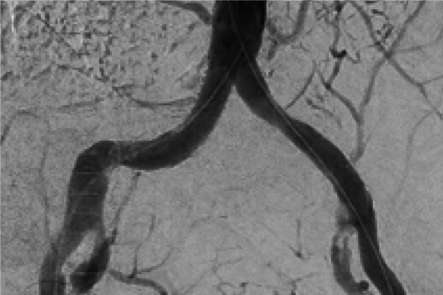 Bilateral Iliac artery occlusion - post restoration