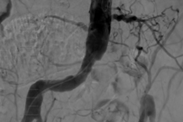 Bilateral Iliac artery occlusion - pre restoration Bilateral Iliac artery occlusion - pre restoration