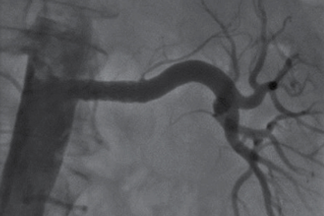 Renal artery stenosis - post restoration