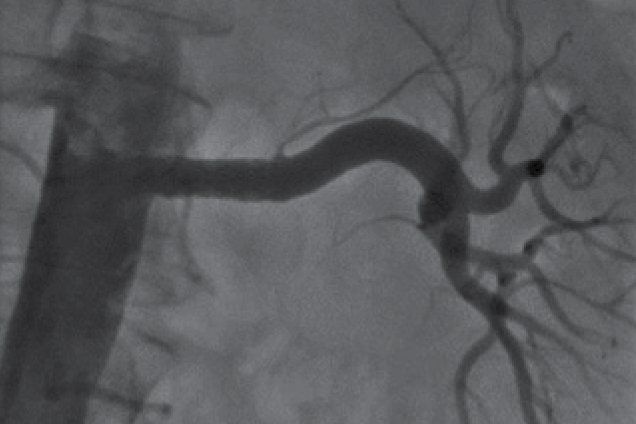Renal artery stenosis - post restoration Renal artery stenosis - post restoration