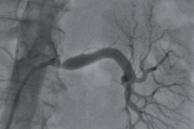 Renal artery stenosis - pre restoration