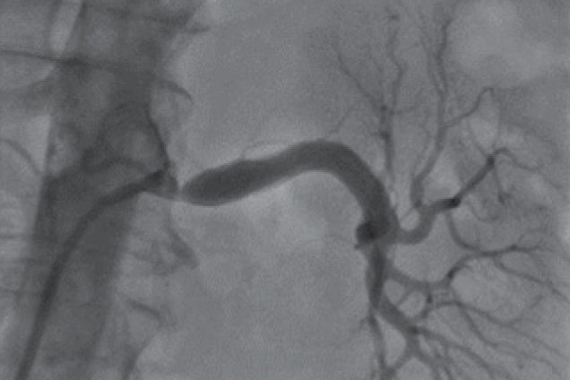 Renal artery stenosis - pre restoration Renal artery stenosis - pre restoration