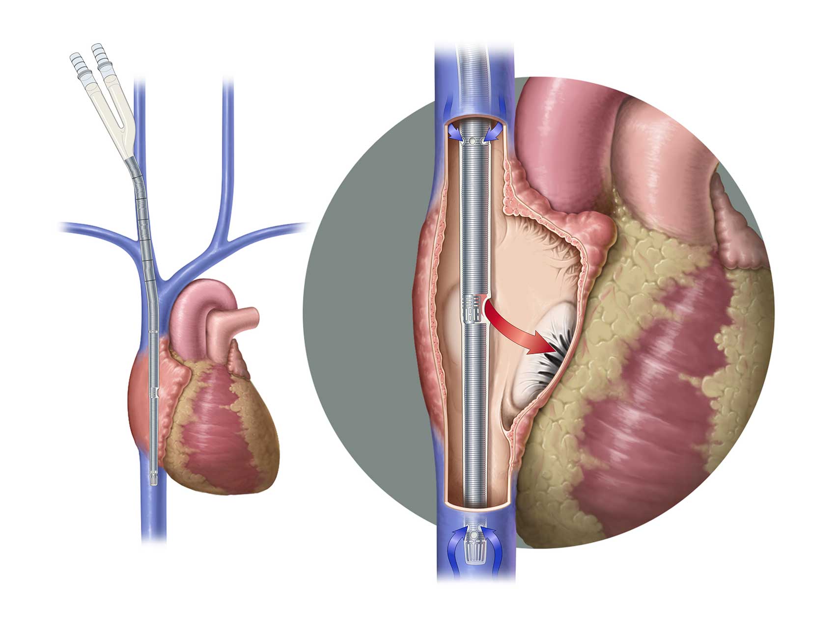 Avalon Elite Bi-Caval Dual-Lumen Catheter inserted into the patient’s internal jugular vein.