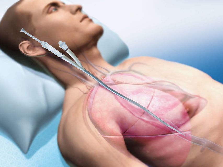 Avalon Elite Bi-Caval Dual-Lumen Catheter inserted into the patient’s internal jugular vein.