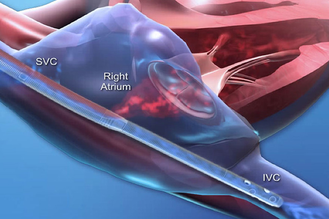 Avalon Elite catheter