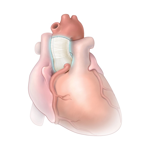 Cardioroot is a durable cardiovascular graft that supports all types of complex aoric root surgeries.  
