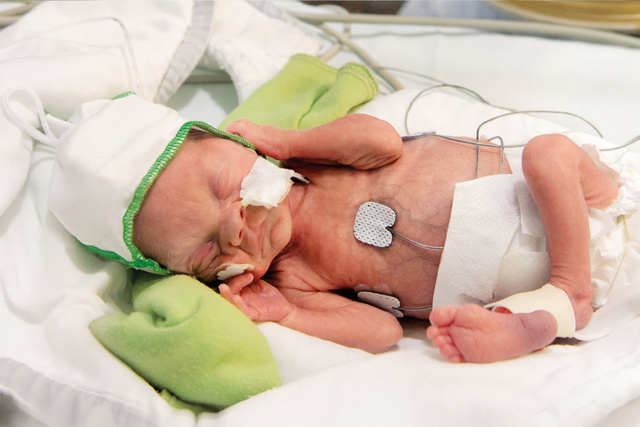 Neonatal patient in incubator with Edi ENFit catheter in nose.