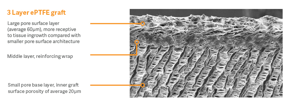 3 Layer ePTFE image with labels 3 Layer ePTFE image with labels