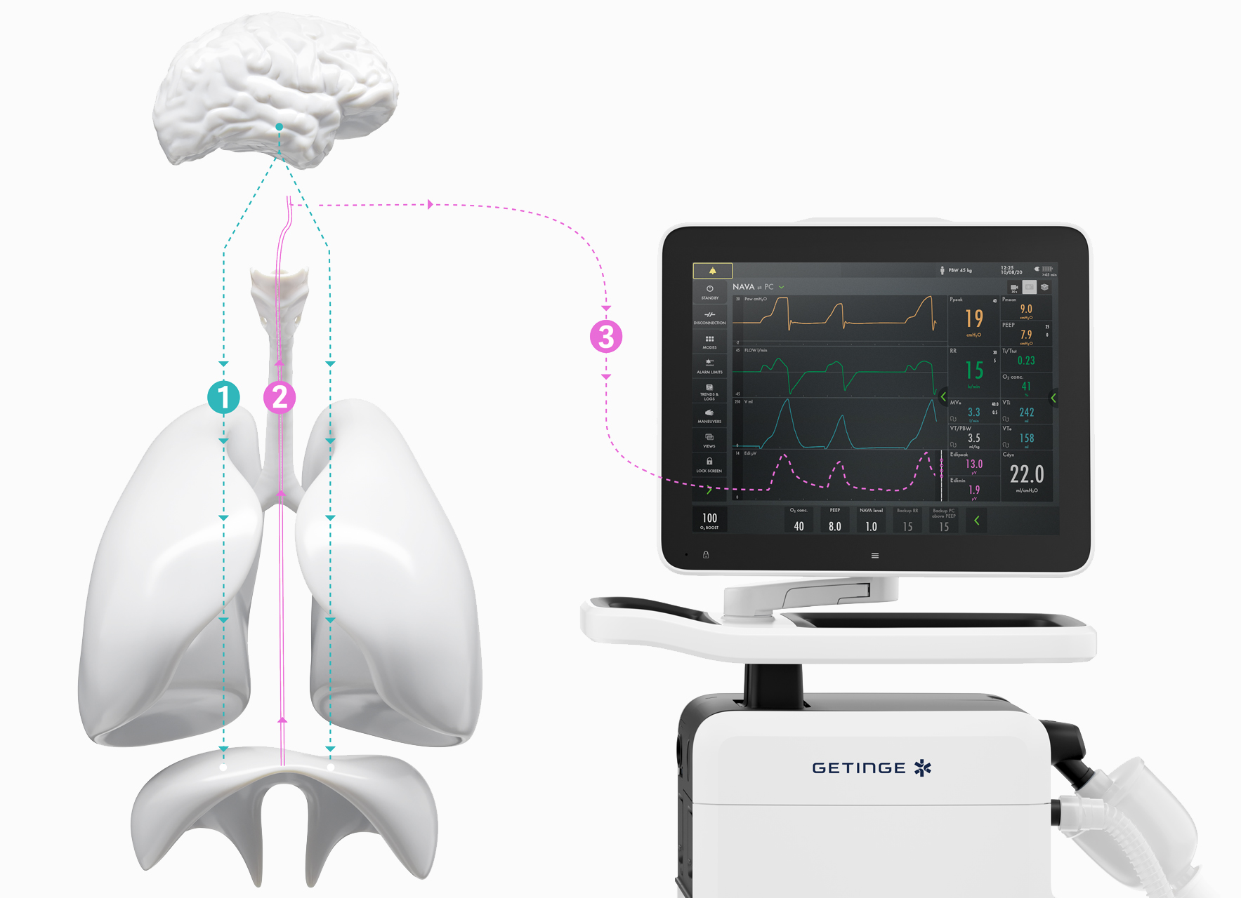 Learn how NAVA neurally adjusted ventilator assist delivers a more personalized level of ventilation to your patient 