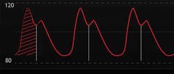 Arterial pulse contour analysis Arterial pulse contour analysis