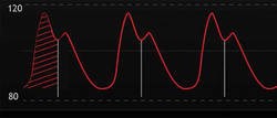 Arterial pulse contour analysis