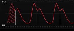 Arterial pulse contour analysis