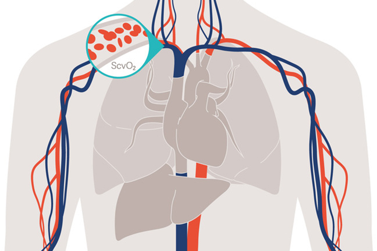 ScvO2 monitoring CeVOX detects acute changes in systemic balance between oxygen delivery and consumption