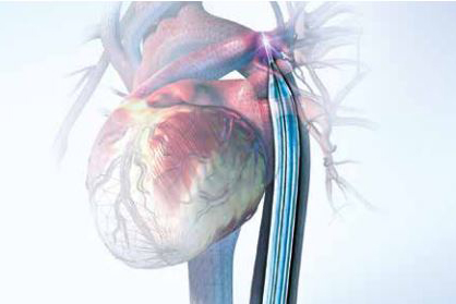 The 7Fr. catheter The 7Fr. catheter