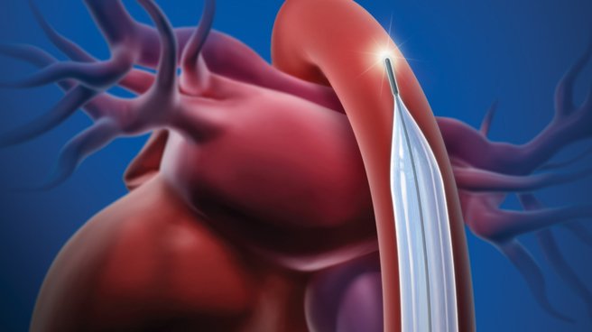 sensation plus iab catheter illustration