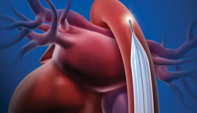 sensation plus iab catheter illustration