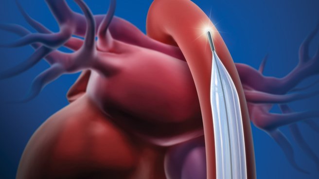 sensation plus iab catheter illustration sensation plus iab catheter illustration