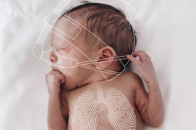 Neonate, NAVA, neurally adjusted ventilatory assist, personalized ventilation, PRVC, improved compliance, lung protection Neonate, NAVA, neurally adjusted ventilatory assist, personalized ventilation, PRVC, improved compliance, lung protection