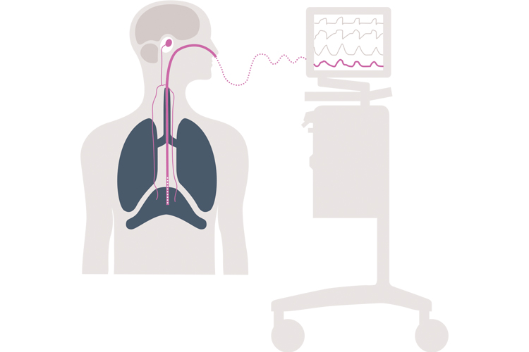 Getinge Servou® the simple to use safer to learn mechanical ventilator