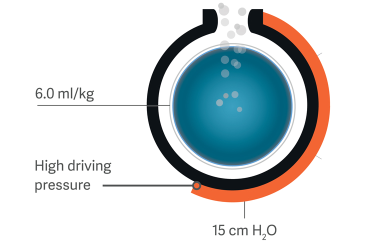 Getinge Servou® the simple to use safer to learn mechanical ventilator