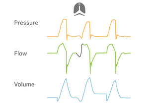 Target protective tidal volumes