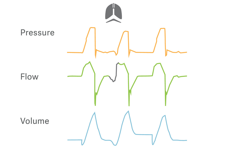 Target protective tidal volumes Target protective tidal volumes