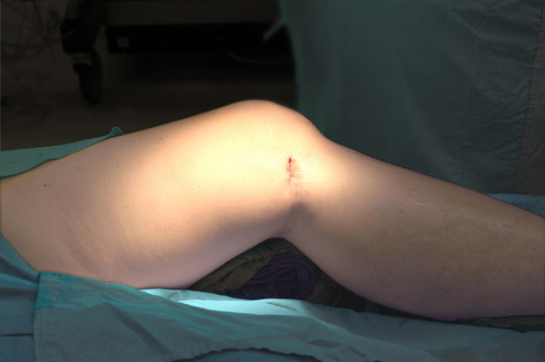 Leg with small incision wound