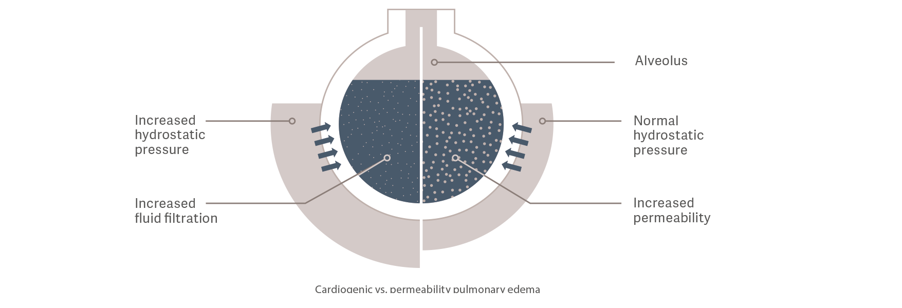 Cardiogenic vs. permeability pulmonary edema Cardiogenic vs. permeability pulmonary edema