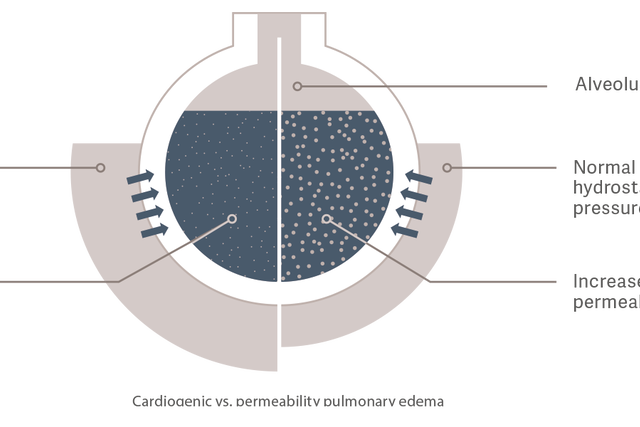 Cardiogenic vs. permeability pulmonary edema