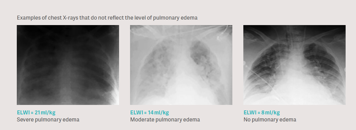 Pulmonary edema Pulmonary edema