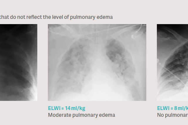 Pulmonary edema