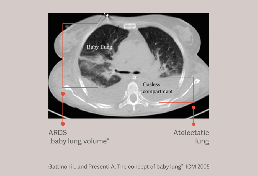 Gattinoni L and Presenti A. The concept of baby lung”  ICM 2005