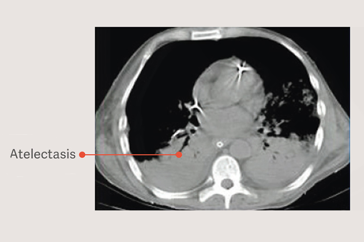 Atelectasis lung Atelectasis lung