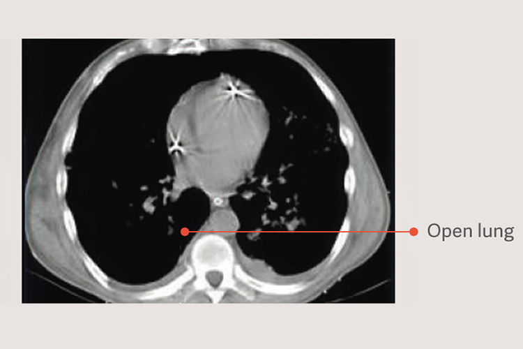 Open lung Open lung