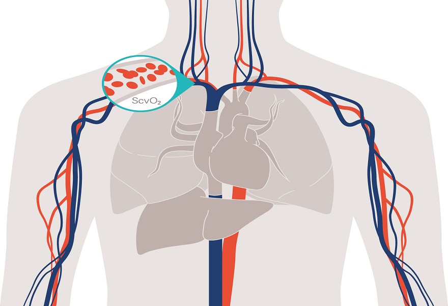 CevOX hemodynamic monitoring of hypoxic episodes CeVOX advanced hemodynamic monitoring of patient's oxygen balance