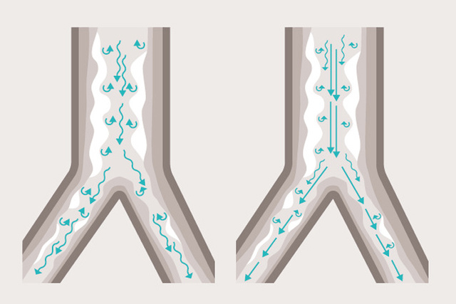 Heliox therapy promotes a smoother airflow and easier work of breathing in a typical asthma patient